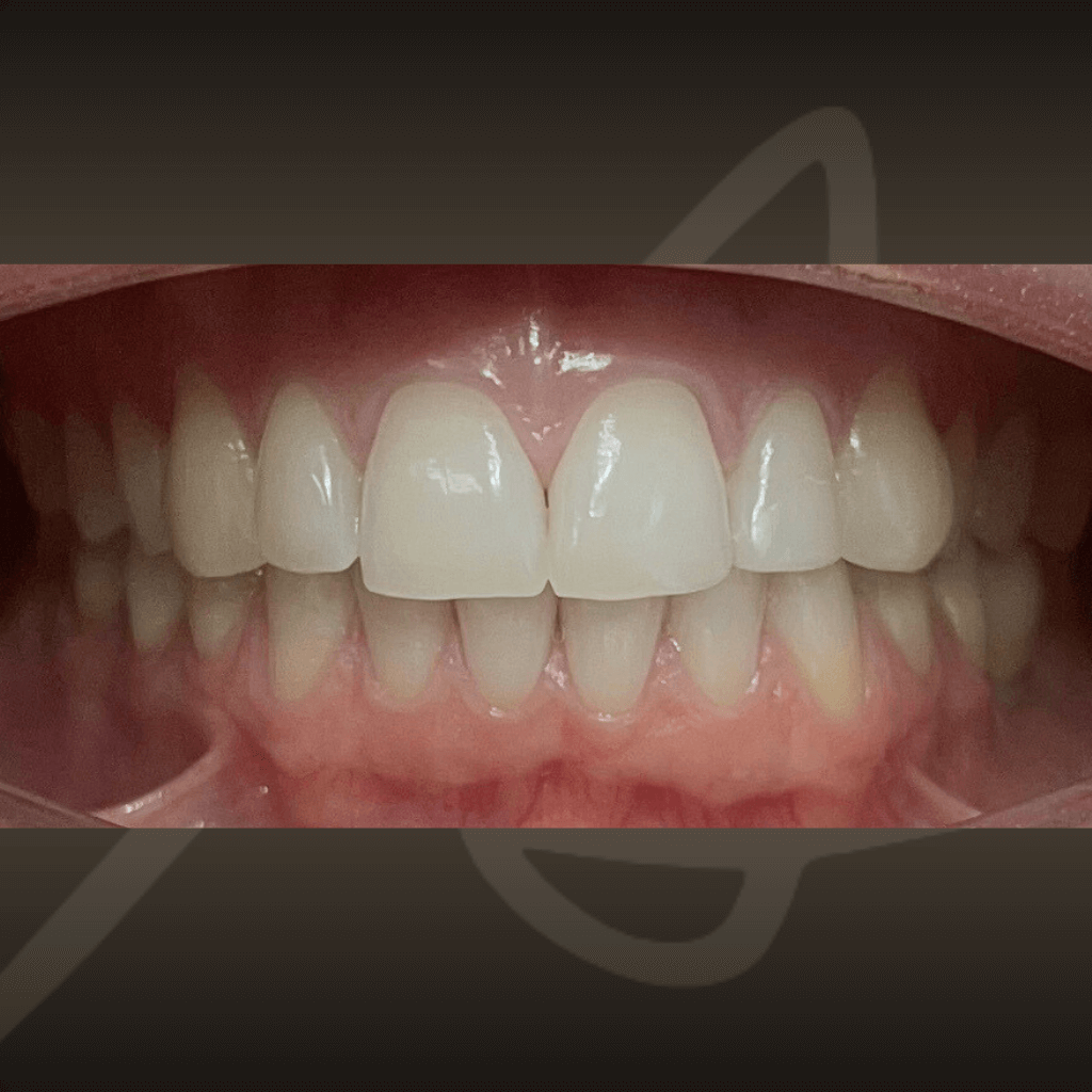 Фронтален интраорален изглед преди ортодонтско лечение с алайнери – неправилна подредба на зъбите.