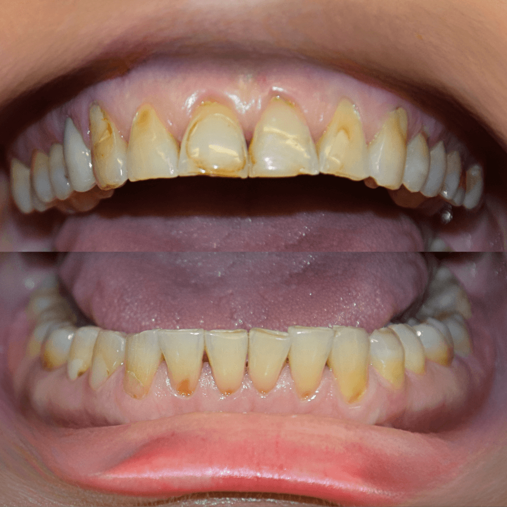 Фронтален изглед на зъбите преди естетичен бондинг на горна и долна челюст – изразени пигментации, неравни режещи ръбове и естетични несъвършенства.