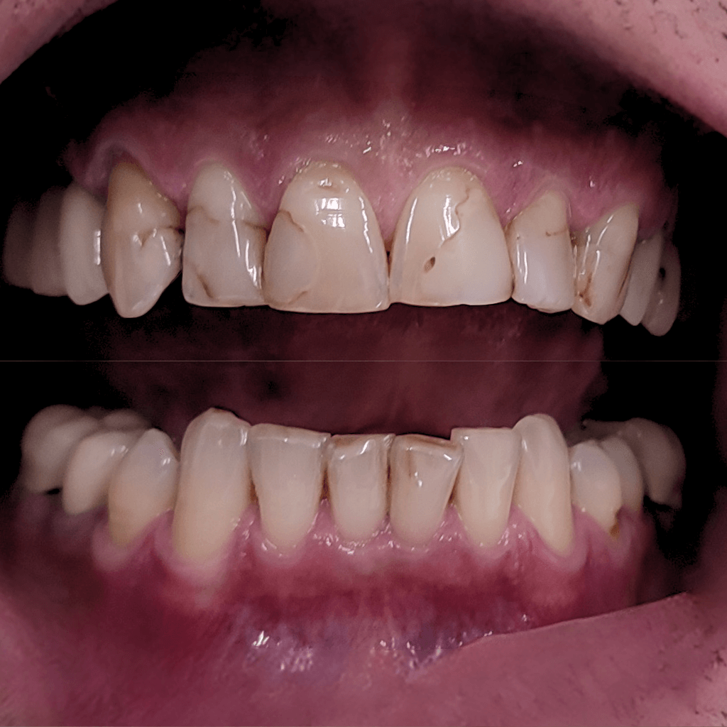 Фронтален интраорален изглед преди естетичен бондинг – видими пигментации, микропукнатини и неравности по повърхността на предните зъби.