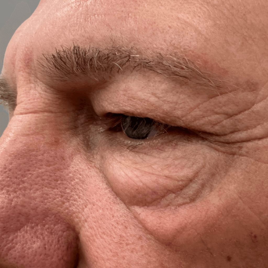 Близък план на околоочната зона с изразени бръчки и отпускане на кожата в областта на долния клепач – признаци на стареене около очите.