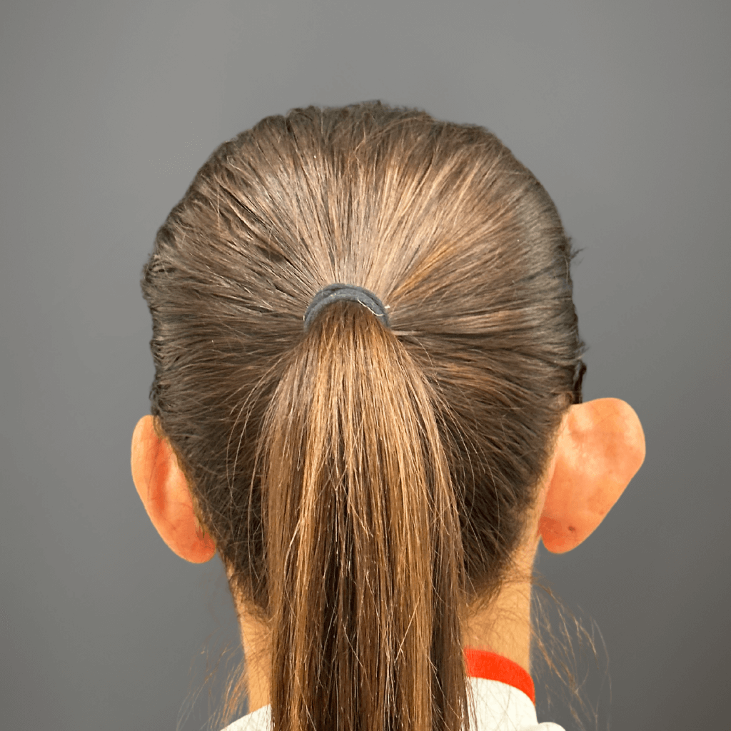 Заден изглед на ушите преди едностранна отопластика, с изразено отстояние на едната ушна мида.