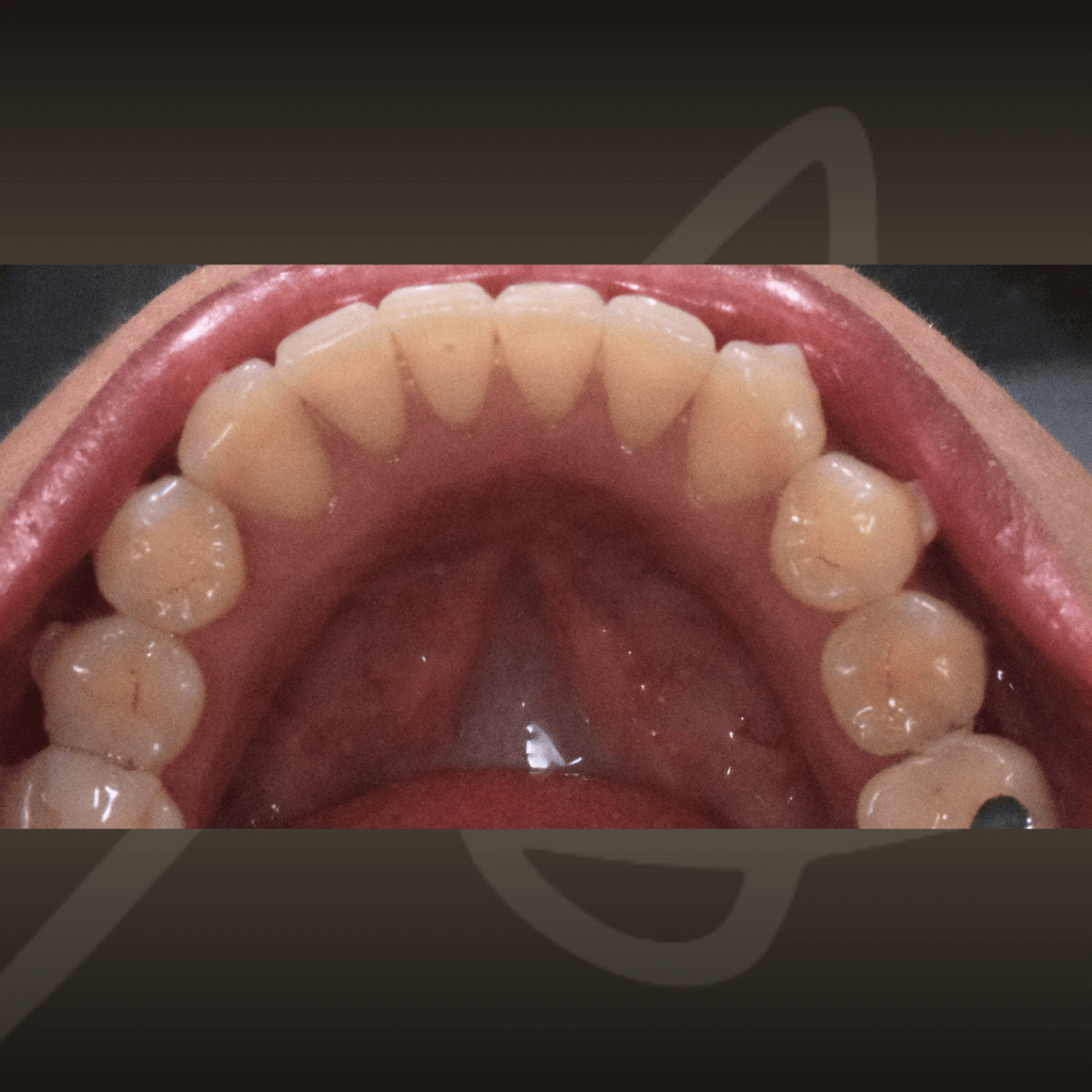 Оклузален изглед на долна челюст след ортодонтско лечение с алайнери – симетрична и стабилна дъга.