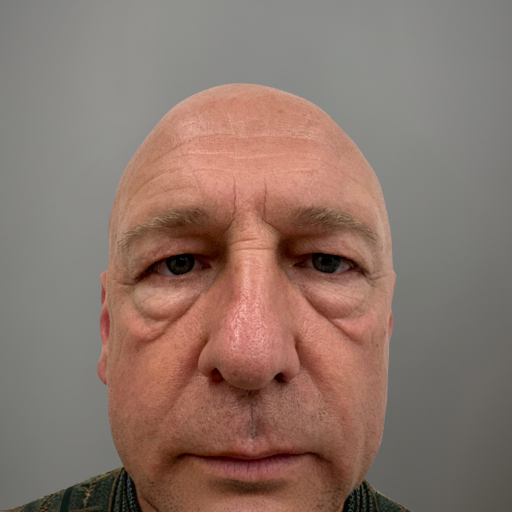 Фронтален портрет на мъж с изразени торбички под очите и отпускане на долните клепачи – състояние преди естетична процедура.