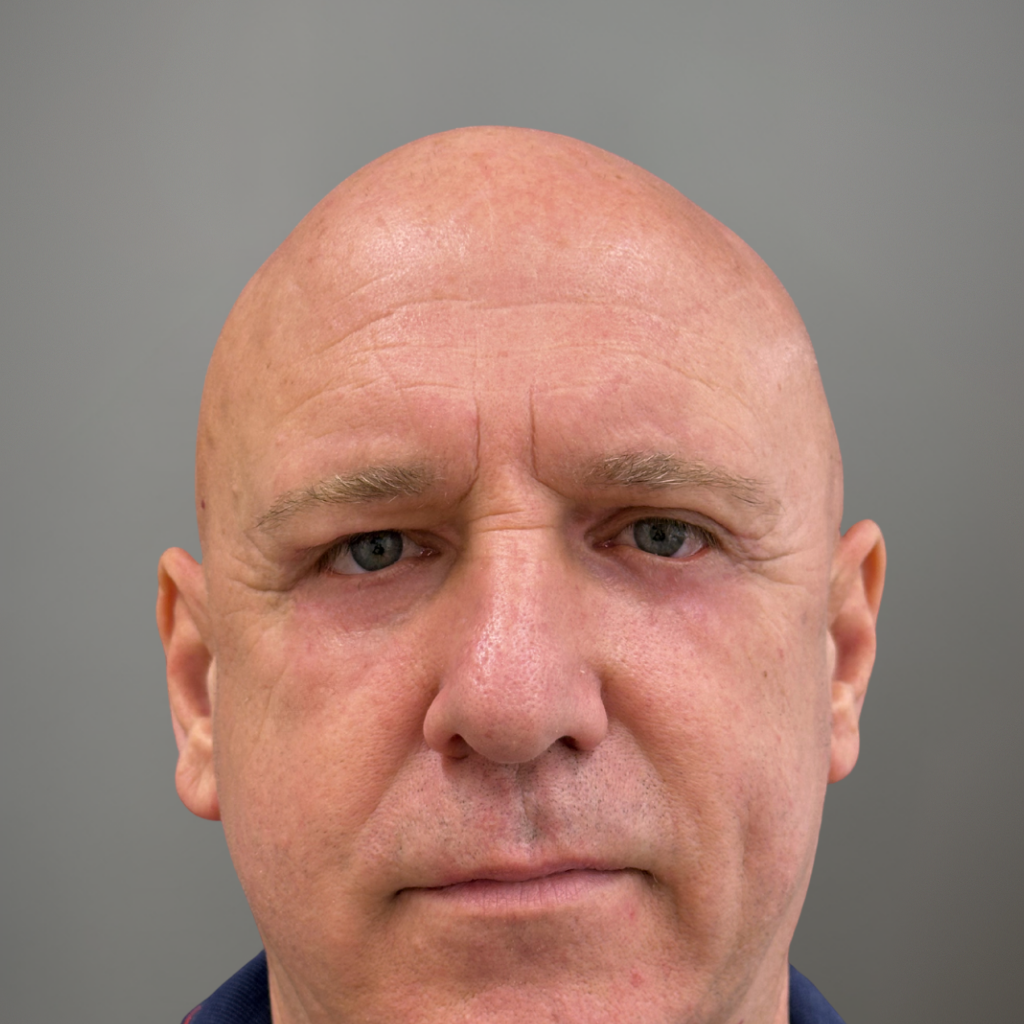 Фронтален изглед на лице с по-изгладена околоочна зона и намалено отпускане на клепачите – резултат след естетична корекция.