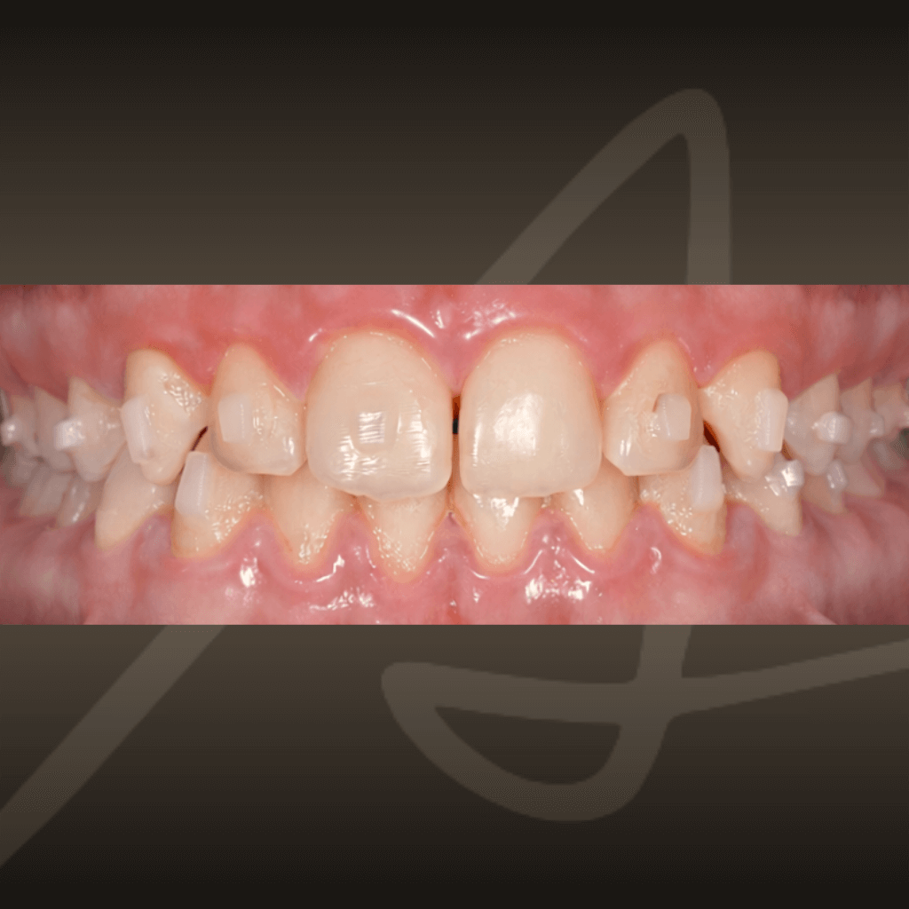 Интраорален изглед след ортодонтско лечение с прозрачни алайнери – подобрена подредба на зъбите и хармонична оклузия.