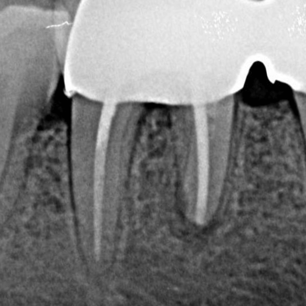 Контролна рентгенография след ендодонтско лечение – кореновите канали са прецизно обработени и херметично запълнени, с възстановена коренова структура и стабилен апикален резултат.