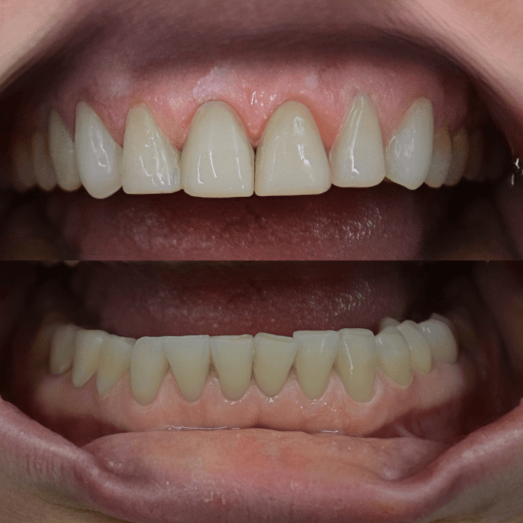 Фронтален изглед на зъбите след естетичен бондинг на горна и долна челюст – възстановена форма и дължина на зъбите, изравнен цвят и хармоничен естетичен резултат.