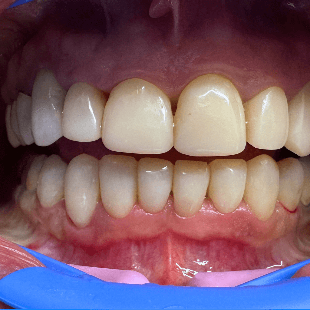 Фронтален интраорален изглед след естетичен бондинг – възстановена форма и пропорции на предните зъби, изравнен цвят и значително подобрен естетичен резултат.