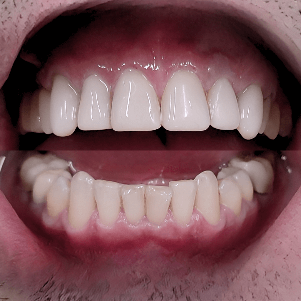 Фронтален интраорален изглед след естетичен бондинг – изгладени повърхности, изравнен цвят и възстановена форма на предните зъби.