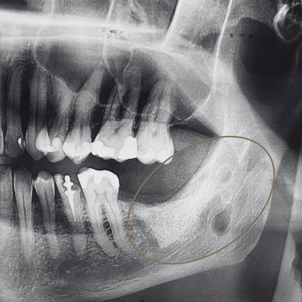 Контролна панорамна рентгенография след хирургично отстраняване на киста на долната челюст – възстановяване на костната структура в засегнатата зона.