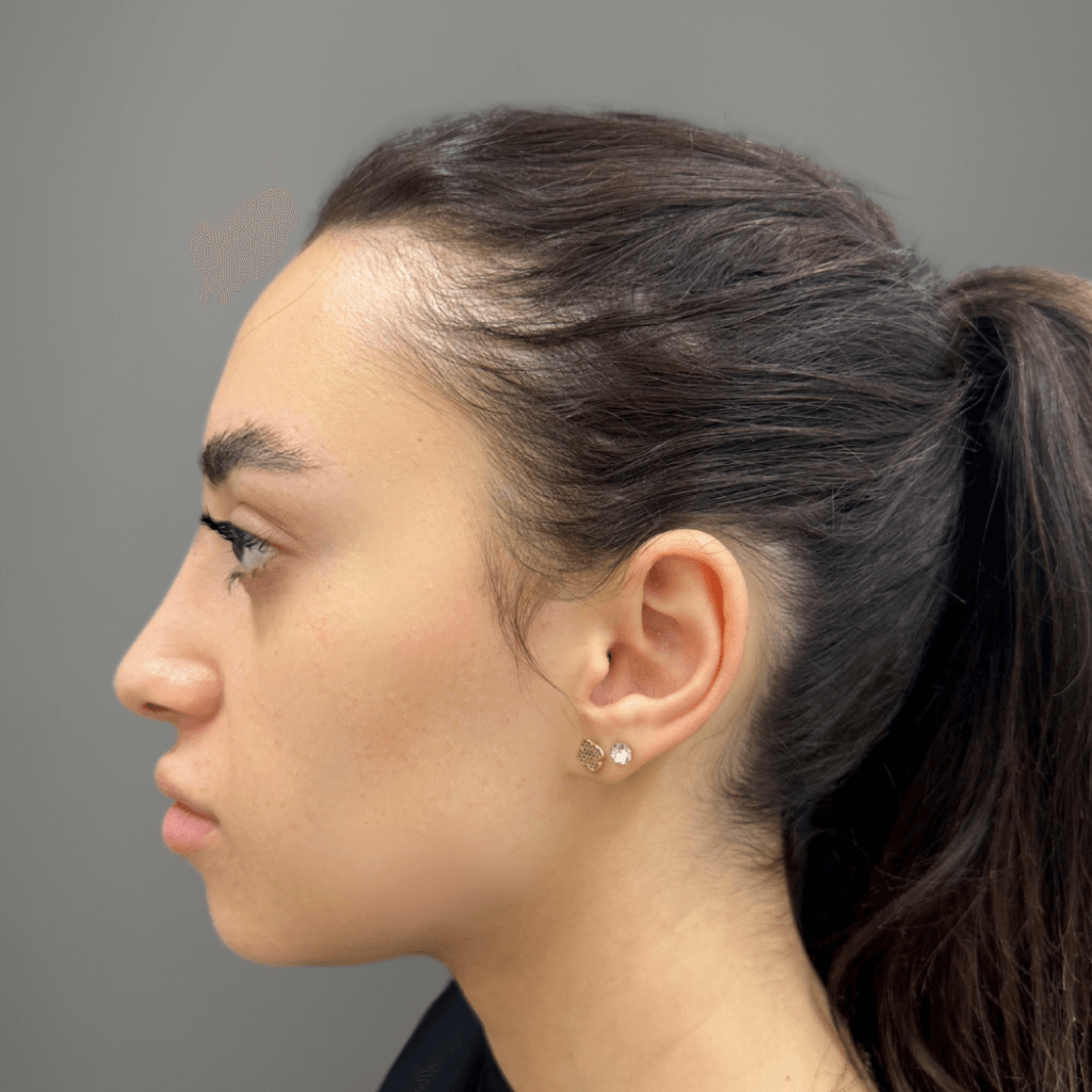 Профилен изглед на лице след ринопластика, с коригиран носен профил и балансирани лицеви пропорции.