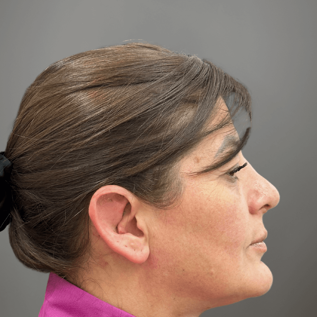 Профилен изглед на лице след ринопластика, с коригиран носен контур и по-хармонични лицеви пропорции.