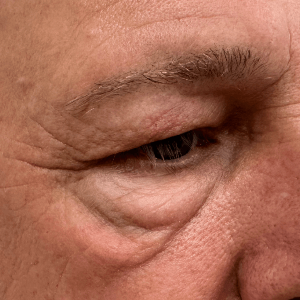 Околоочна област с торбички под очите и фини линии на долния клепач – детайлна клинична визуализация преди естетична корекция.