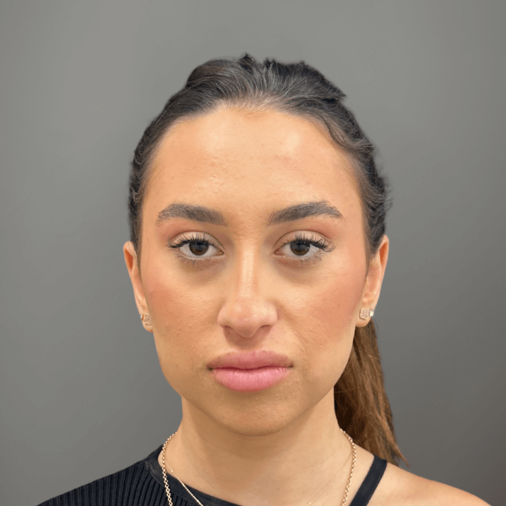 Фронтален изглед на лице преди ринопластика, с асиметрия и подчертана форма на носа.