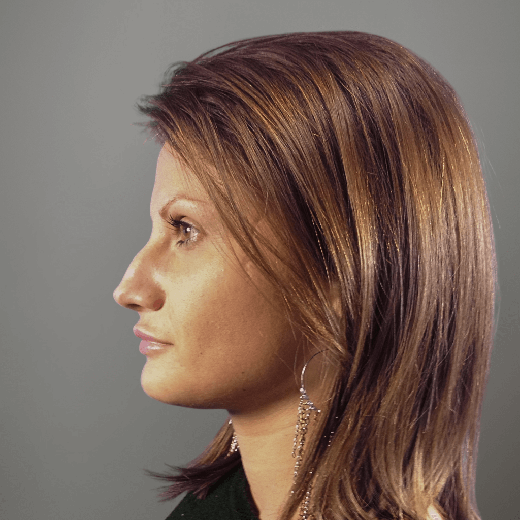 Профилен изглед на лице преди ринопластика, с изразен гръб на носа и нарушен профилен баланс.