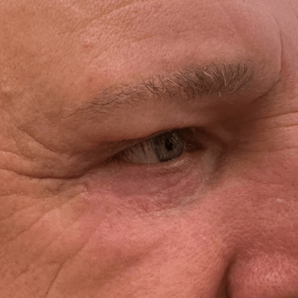 Детайлен изглед на околоочната област след естетична корекция, с по-гладка кожа и редуцирани сенки под очите.