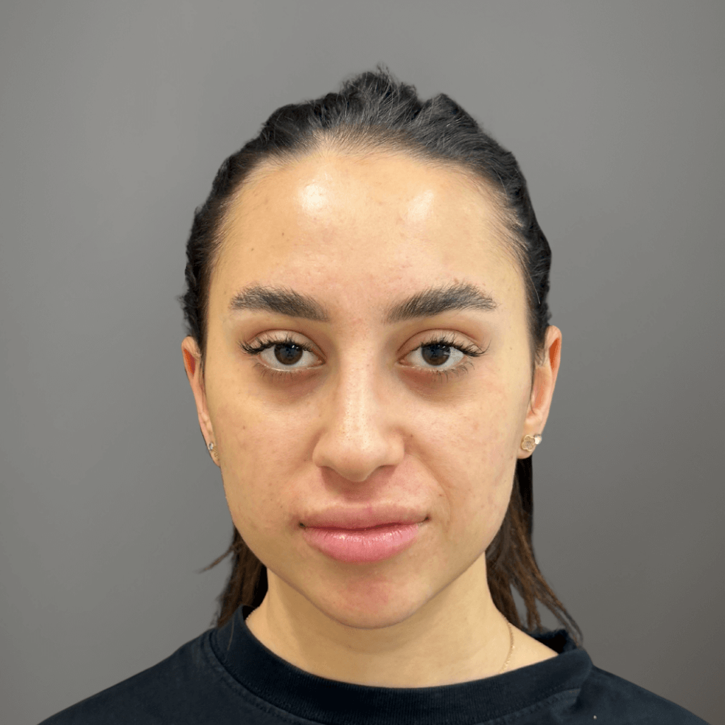 Фронтален изглед на лице след ринопластика, с подобрена симетрия и хармонична форма на носа.