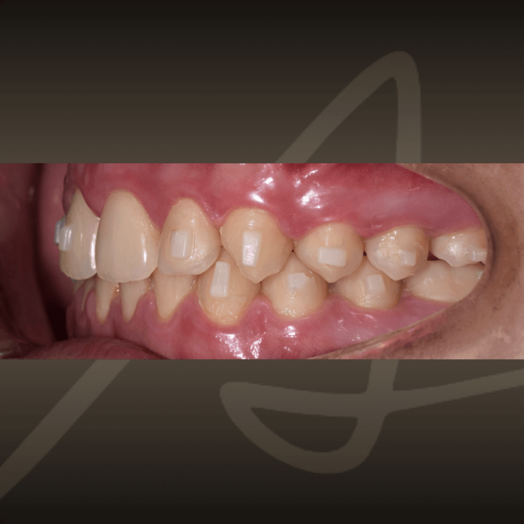 Страничен интраорален изглед след лечение с алайнери – коригирана захапка и подравнени зъбни повърхности.