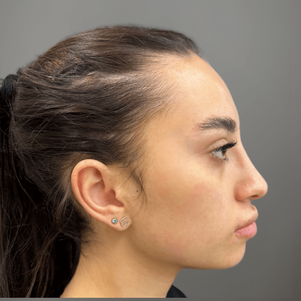 Профилен изглед на лице след ринопластика, с изгладен носен контур и естествена линия.