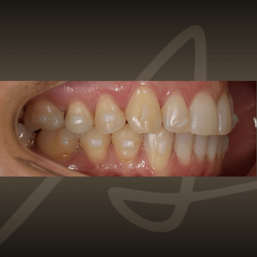 Интраорален изглед след ортодонтия с алайнери – равномерно подредени зъбни редици.