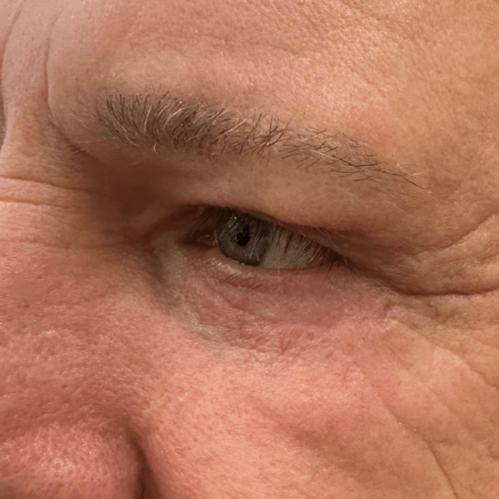 Околоочна област без торбички под очите и фини линии на долния клепач – детайлна клинична визуализация след естетична корекция.