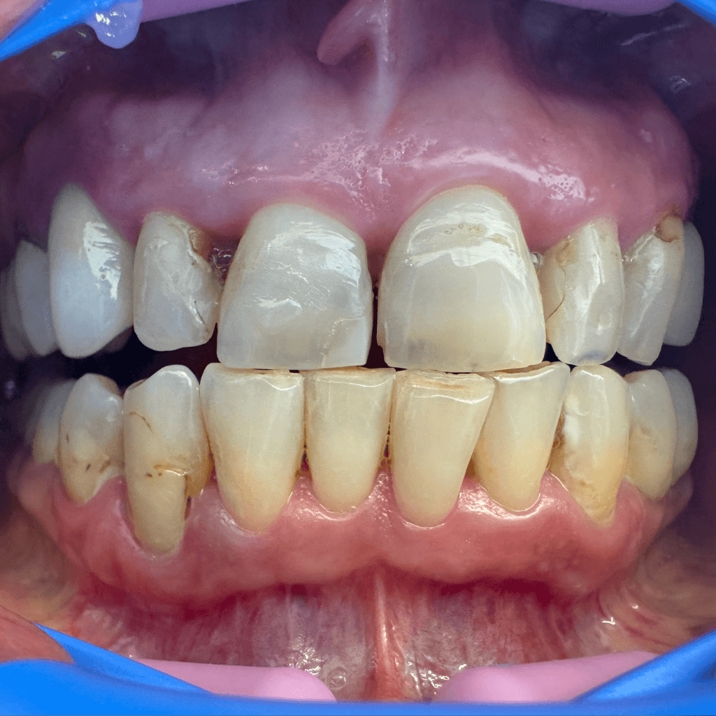 Фронтален интраорален изглед преди естетичен бондинг – изразени пигментации, неравности и износване на предните зъби, нарушена естетика на усмивката.