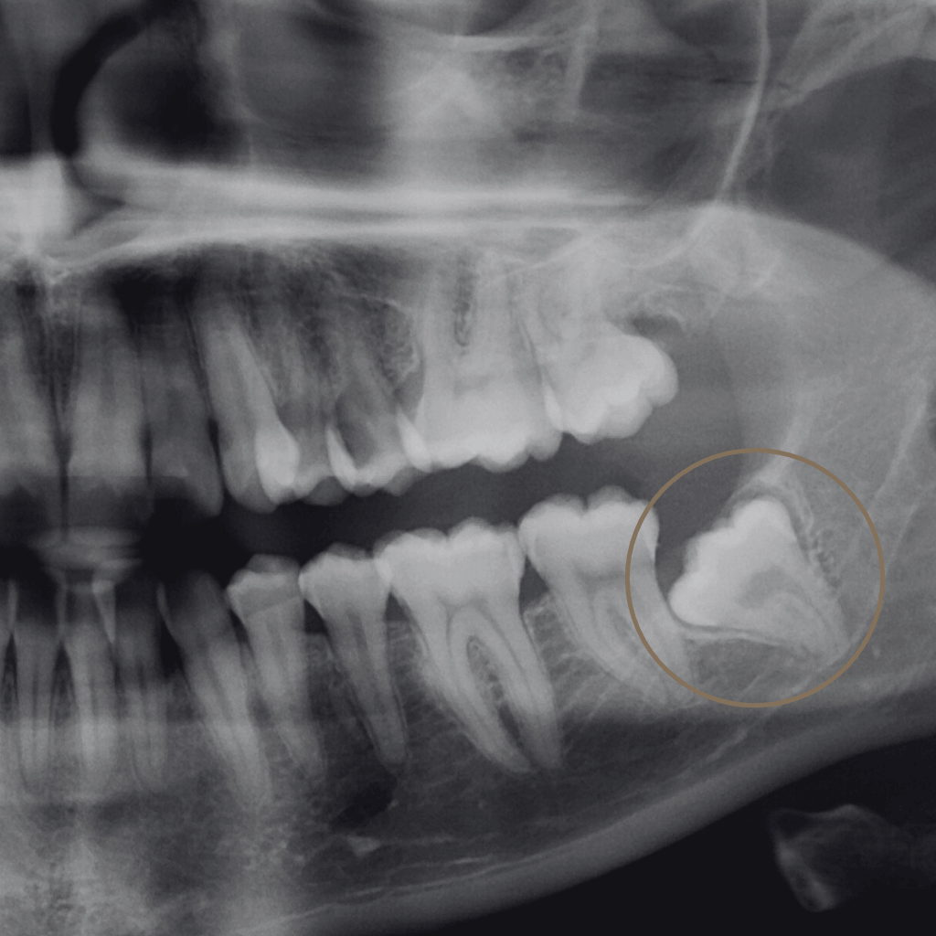 Панорамна рентгенография преди екстракция на ретиниран мъдрец в долна челюст – зъб в дистопична позиция, в близост до мандибуларния канал.