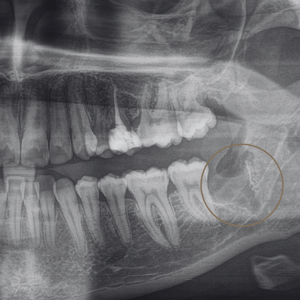 Контролна панорамна рентгенография след хирургична екстракция на мъдрец – липса на зъба и начален процес на костно възстановяване в екстракционната зона.