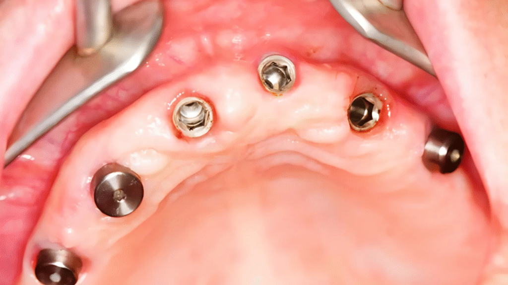 Поставени дентални импланти във фронталната зона на горна челюст – клиничен изглед след хирургичен етап