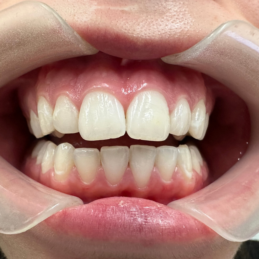 Близък кадър на предни зъби след избелване – зъбите са изсветлени и изглеждат по-здрави.