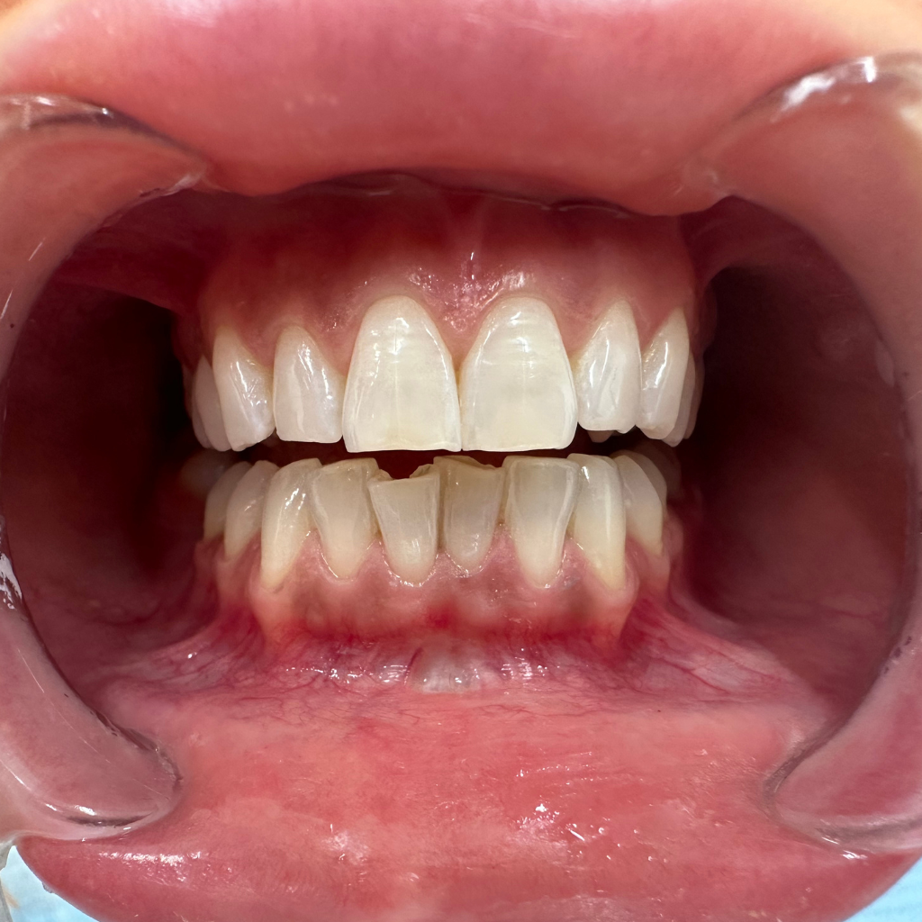 Резултат след избелване на зъби – видимо изсветляване и естествен блясък