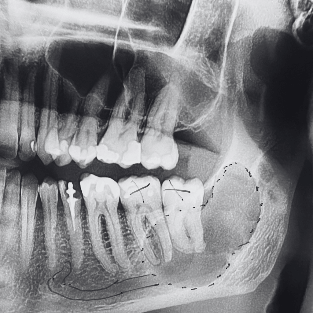 Рентгенография с наличие на киста в долната челюст – ясно очертана костна лезия в областта на долночелюстния ъгъл.