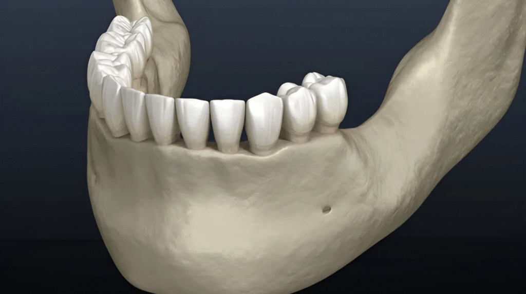 Напреднала костна загуба около зъби – визуализация на пародонтално заболяване с оголени корени