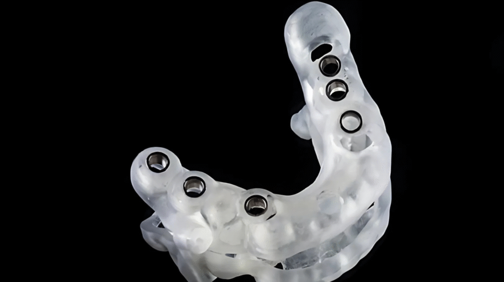 3D отпечатан хирургичен водач за поставяне на зъбни импланти – долна челюст