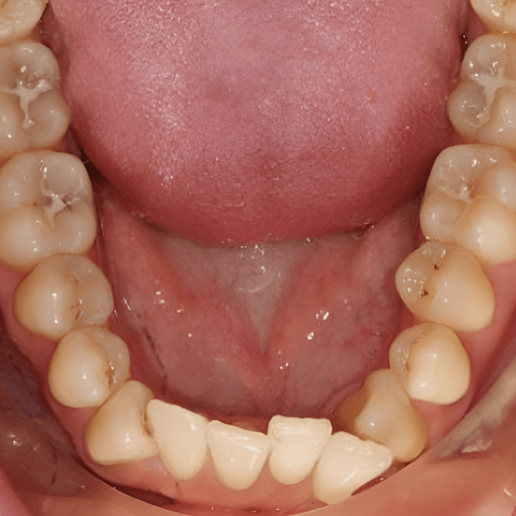 Оклузален изглед преди ортодонтска корекция – струпване на зъбите в долната челюст.