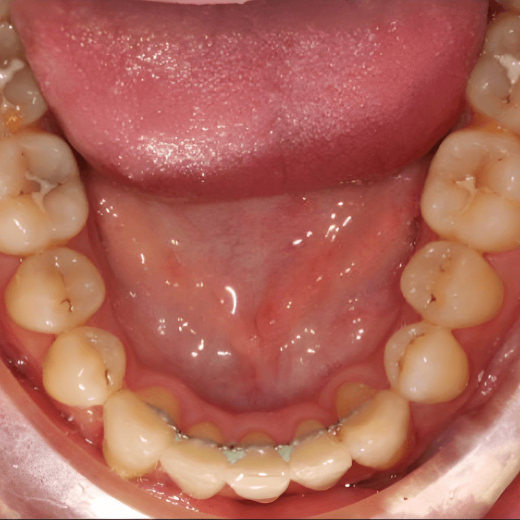 Оклузален изглед след ортодонтско лечение – симетрична и стабилна дъга.