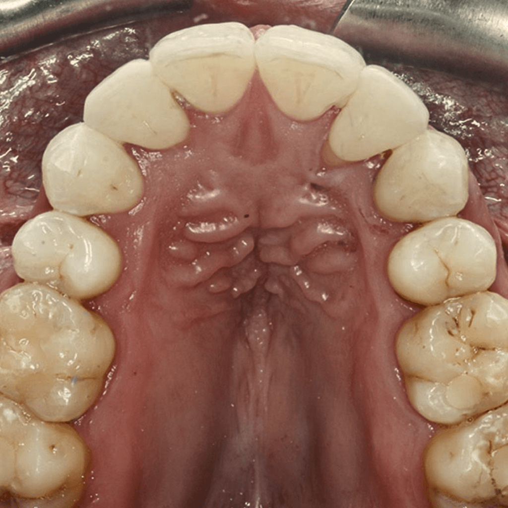 Ортодонтски случай след лечение – добре подредени горни зъби с възстановена симетрия и правилна захапка