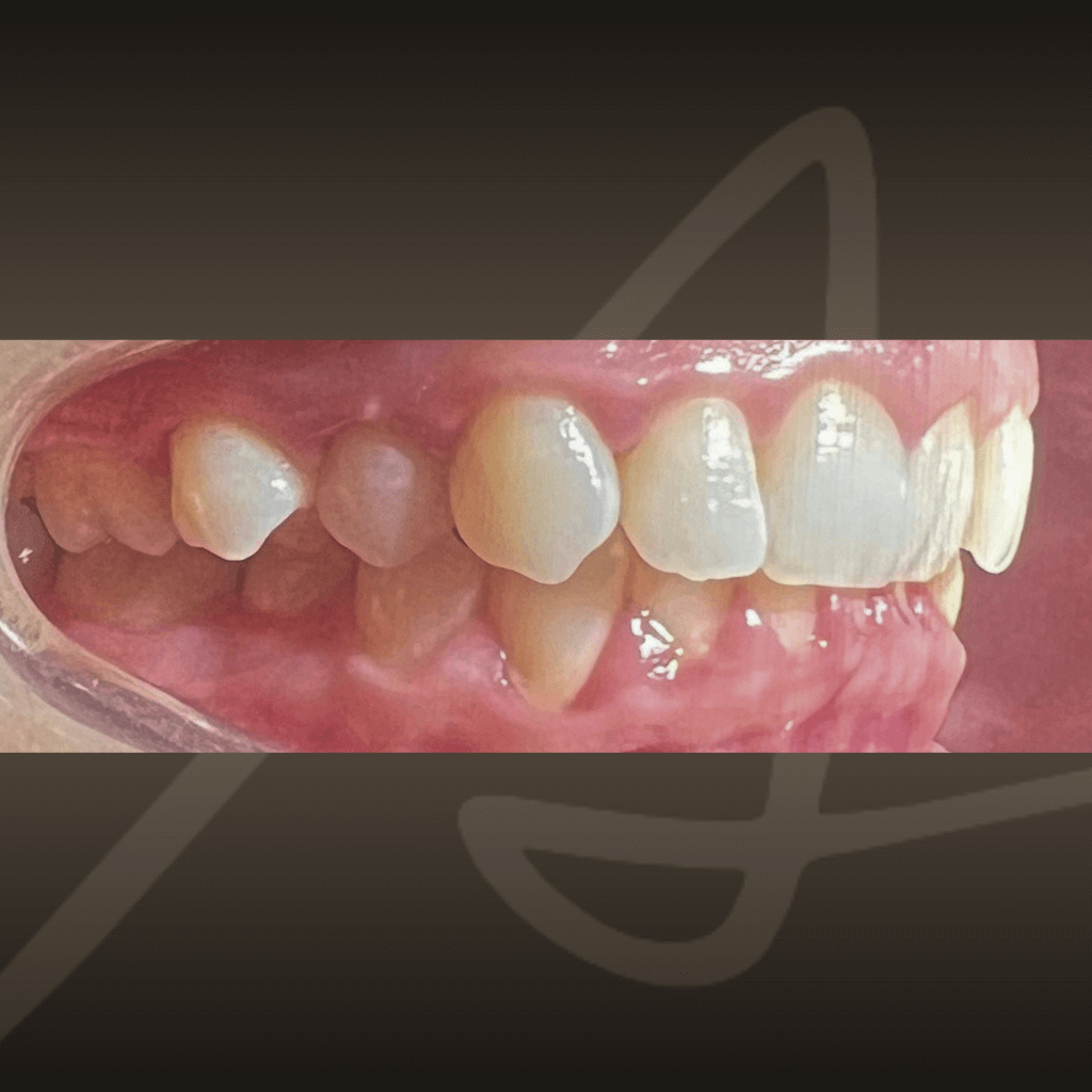 Интраорален изглед на зъбите преди ортодонтско лечение с алайнери, с неправилно подреждане и струпване на зъбите.