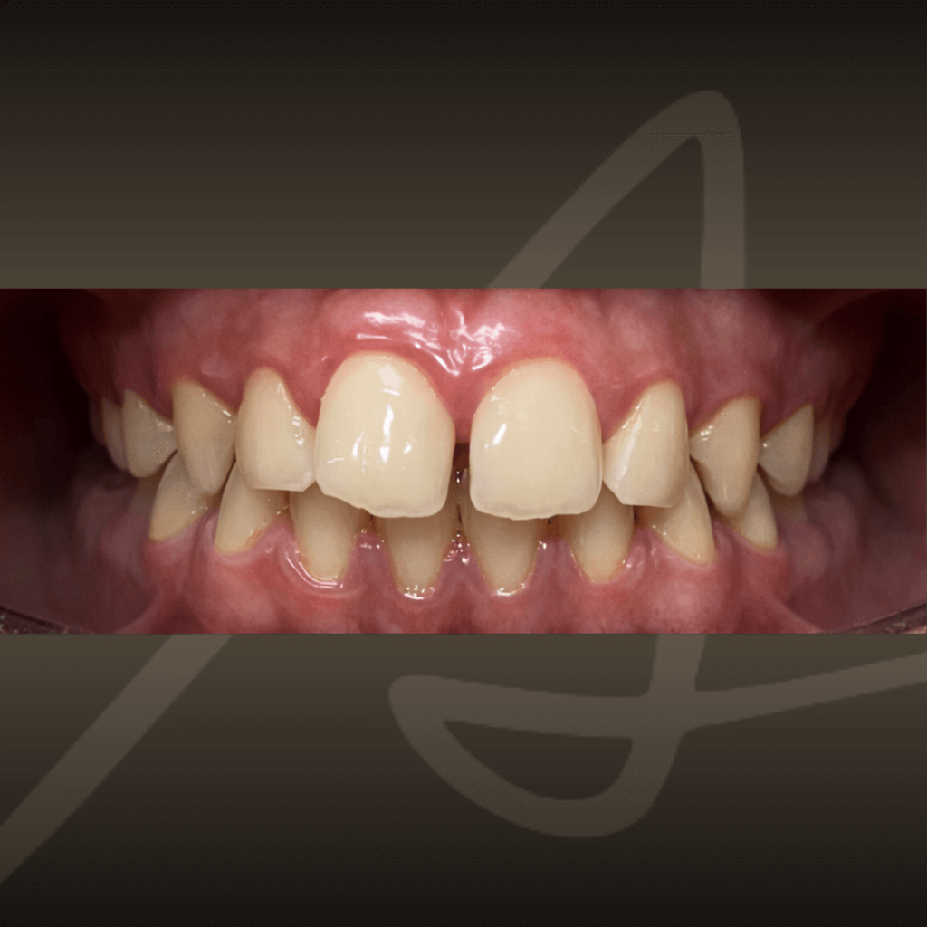 Интраорален изглед на зъбна редица с неправилна подредба и струпване на зъбите преди ортодонтско лечение с алайнери.