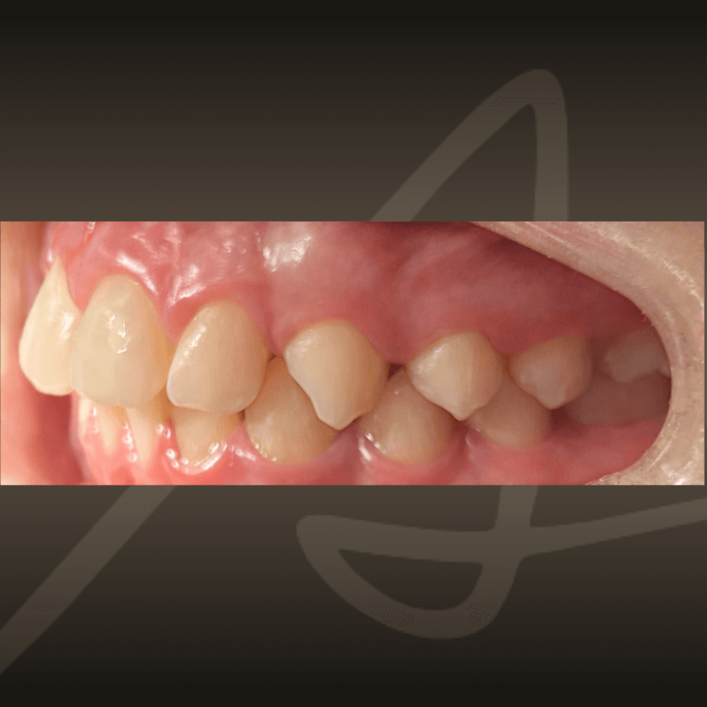 Страничен интраорален изглед с неправилна захапка и ротации на зъбите преди ортодонтско лечение с алайнери.