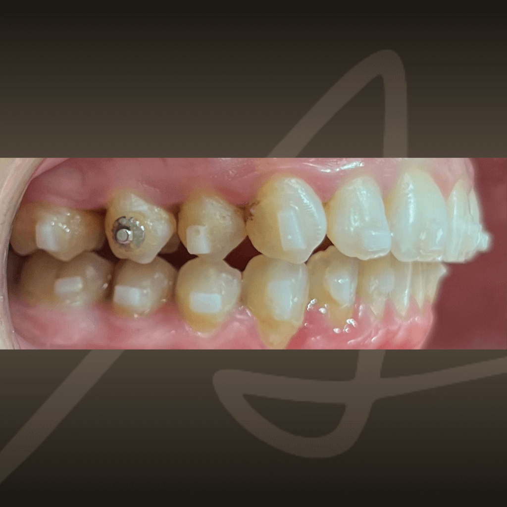 Интраорален изглед на зъбите след ортодонтско лечение с алайнери, с подобрена подредба и коригиран захапен контакт.