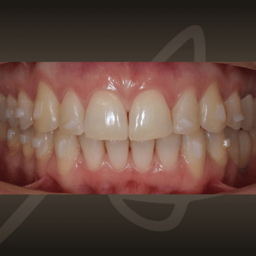 Фронтален интраорален изглед след лечение с алайнери – подравнени зъби и хармонична захапка.