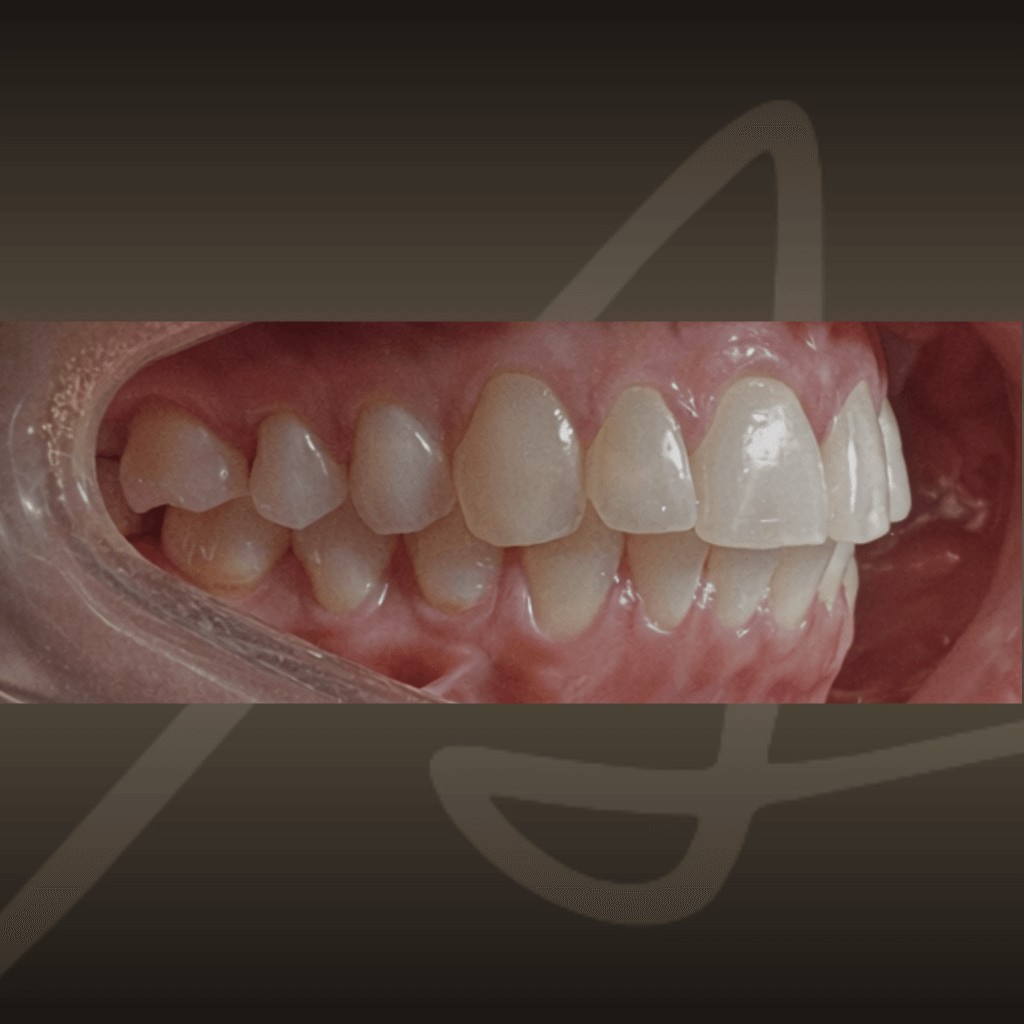 Интраорален изглед преди ортодонтско лечение – ротация на зъбите.