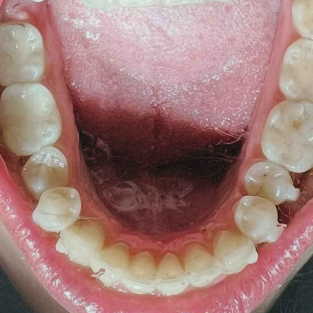Ортодонтски случай след лечение – подредени долни зъби с възстановена дъга и правилно разположение