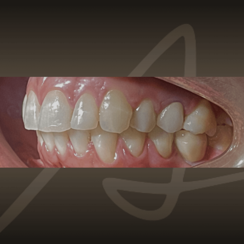 Страничен интраорален изглед преди ортодонтия с алайнери – нарушени оклузални контакти.