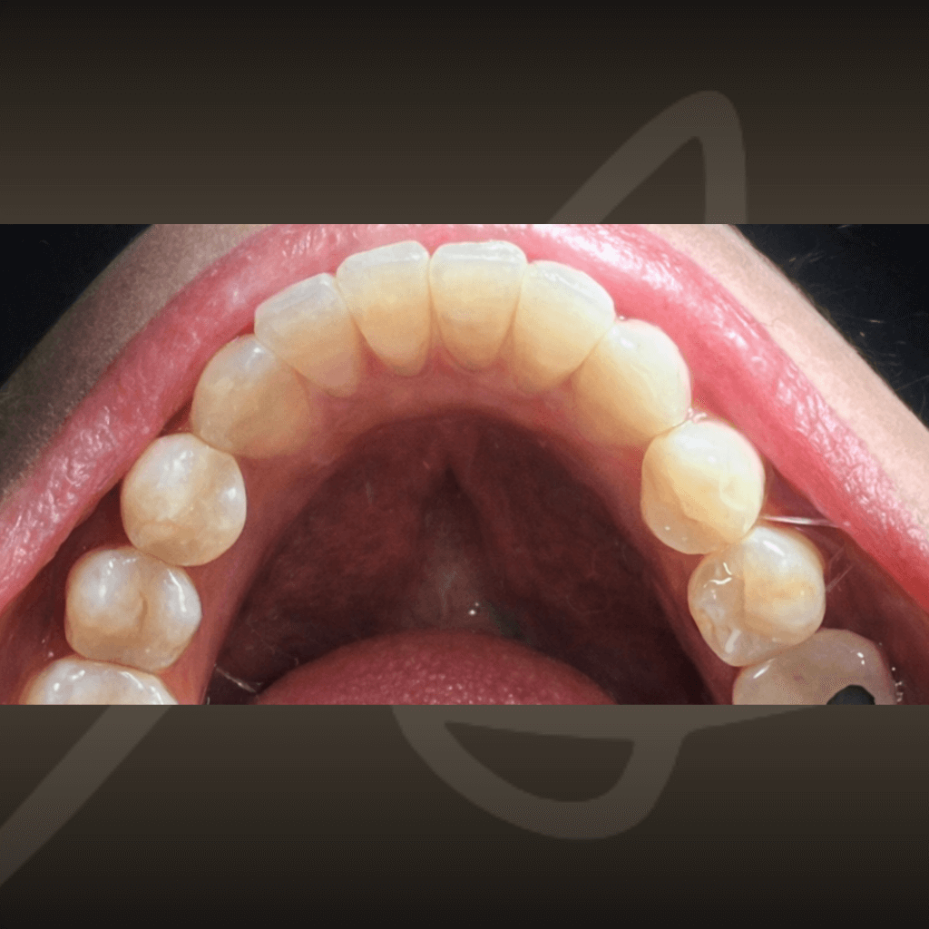 Оклузален изглед преди ортодонтска корекция – неправилна форма на зъбната дъга.