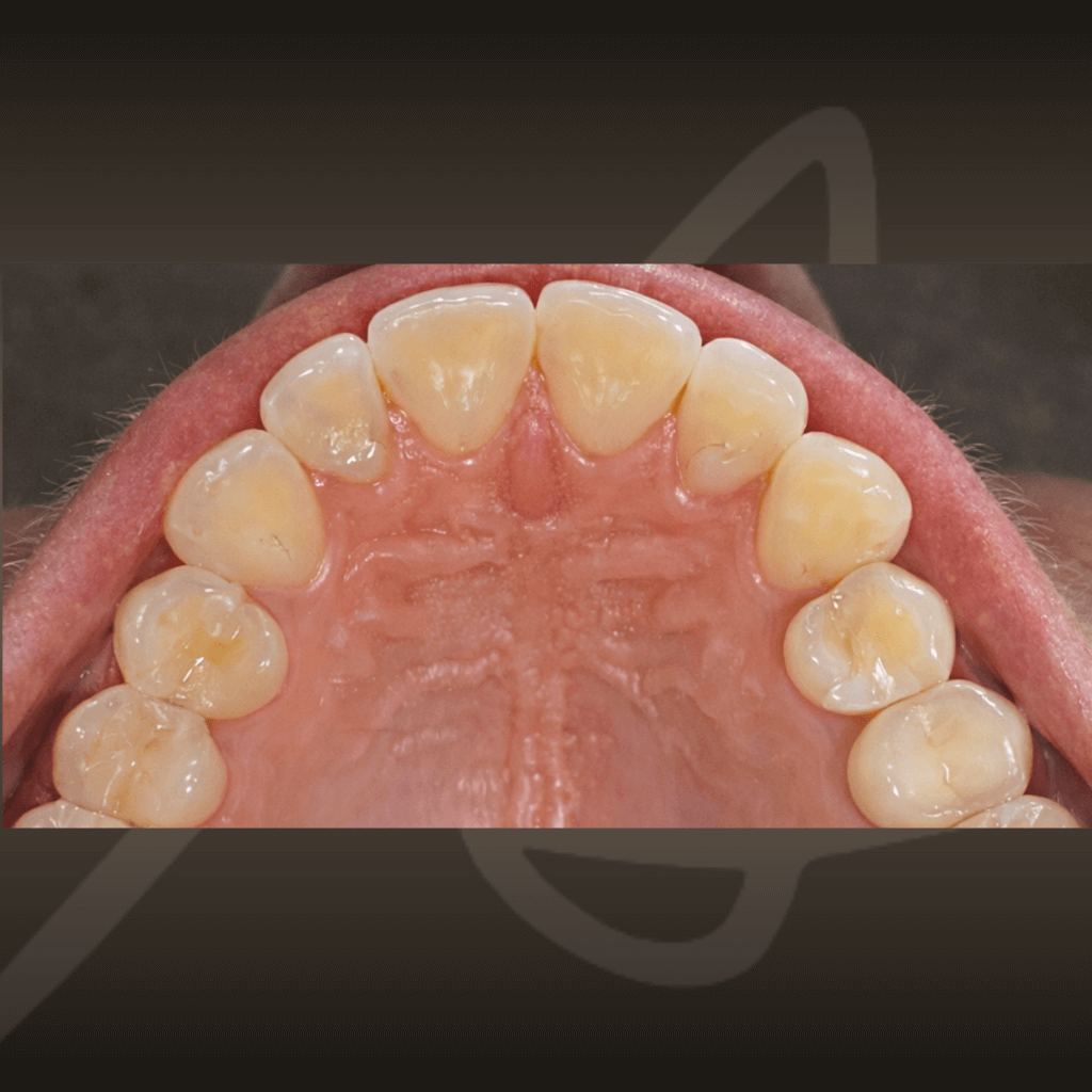 Оклузален изглед на горна челюст преди ортодонтско лечение с алайнери.