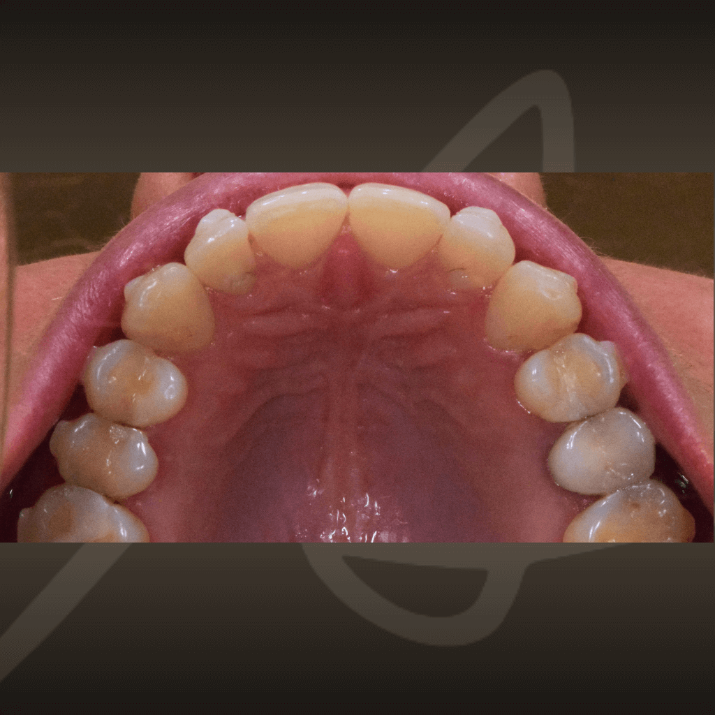 Оклузален изглед на горна челюст след лечение с алайнери – оформена зъбна дъга.