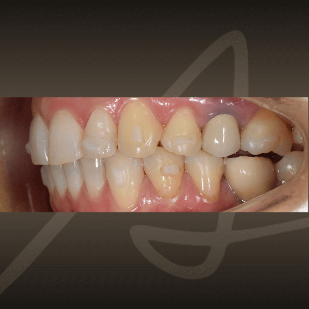 Страничен интраорален изглед след ортодонтско лечение с алайнери – коригирана захапка.