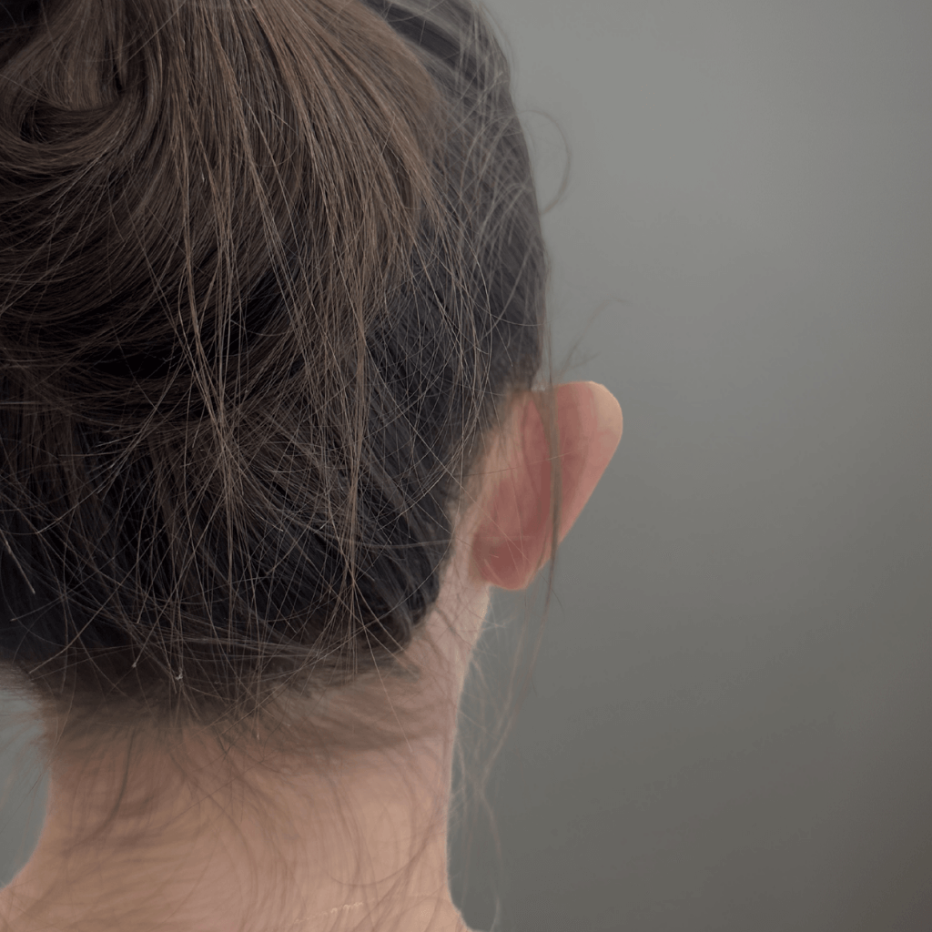 Пациент преди отопластика – поглед отзад с видимо отстояние на ушите